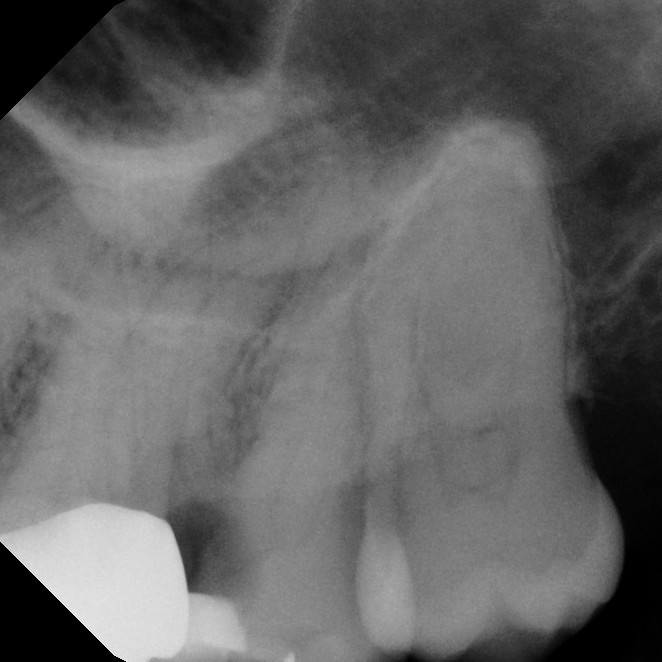 Before Endodontic Treatment Case 3 - Harp Endodontics Manhattan New York